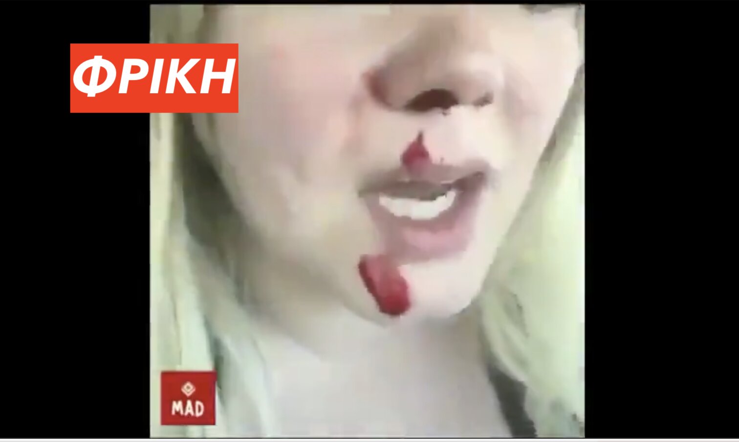 ΦΡΙΚΗ ΜΕΓΑΛΗ – ΠΡΟΣΟΧΗ: Γραφικό βίντεο – Εμβολιασμένη γυναίκα καταφέρνει να αφαιρέσει ΤΕΡΑΣΤΙΟ θρόμβο από τη μύτη της λόγω  του θανατηφόρου μπολιού Κόβιντ!!! – Βίντεο