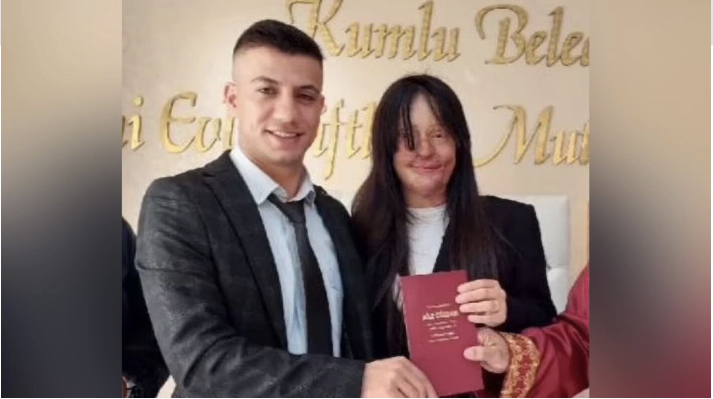 Σάλος στην Τουρκία: 20χρονη παντρεύτηκε τον άνδρα που την παραμόρφωσε με οξύ